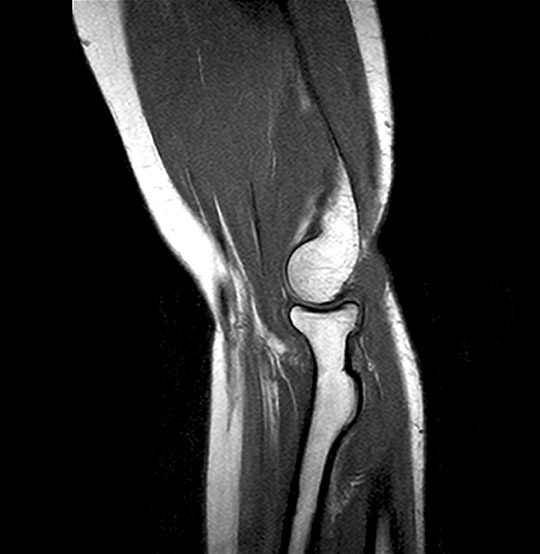 MRI Elbow Sagittal Scan (AI Enhanced)